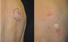 General Reconstruction After Photo by Robert Lowen, MD; Mountain View, CA - Case 50185