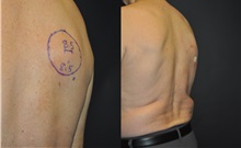 General Reconstruction Before Photo by Robert Lowen, MD; Mountain View, CA - Case 50185