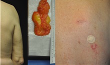 General Reconstruction After Photo by Robert Lowen, MD; Mountain View, CA - Case 50185