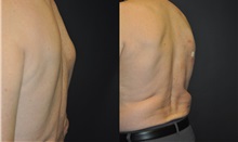 General Reconstruction Before Photo by Robert Lowen, MD; Mountain View, CA - Case 50185