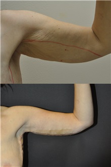 Arm Lift After Photo by Robert Lowen, MD; Mountain View, CA - Case 50186