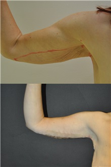 Arm Lift Before Photo by Robert Lowen, MD; Mountain View, CA - Case 50186