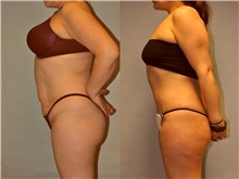Liposuction After Photo by Robert Lowen, MD; Mountain View, CA - Case 50193
