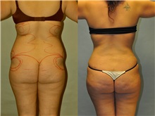 Liposuction Before Photo by Robert Lowen, MD; Mountain View, CA - Case 50193