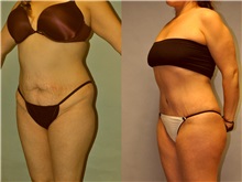 Liposuction After Photo by Robert Lowen, MD; Mountain View, CA - Case 50193