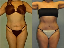 Liposuction Before Photo by Robert Lowen, MD; Mountain View, CA - Case 50193