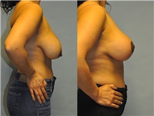 Breast Lift After Photo by Robert Lowen, MD; Mountain View, CA - Case 50187