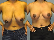 Breast Lift Before Photo by Robert Lowen, MD; Mountain View, CA - Case 50187