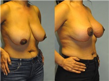 Breast Lift After Photo by Robert Lowen, MD; Mountain View, CA - Case 50187