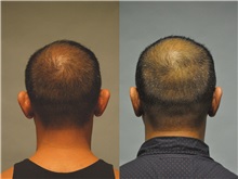 Ear Surgery After Photo by Robert Lowen, MD; Mountain View, CA - Case 50192