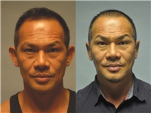 Ear Surgery Before Photo by Robert Lowen, MD; Mountain View, CA - Case 50192