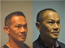 Ear Surgery After Photo by Robert Lowen, MD; Mountain View, CA - Case 50192