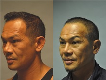 Ear Surgery Before Photo by Robert Lowen, MD; Mountain View, CA - Case 50192