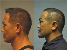 Ear Surgery After Photo by Robert Lowen, MD; Mountain View, CA - Case 50192