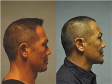 Ear Surgery Before Photo by Robert Lowen, MD; Mountain View, CA - Case 50192