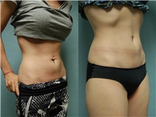 Nonsurgical Fat Reduction After Photo by Robert Lowen, MD; Mountain View, CA - Case 50190