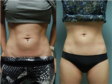 Nonsurgical Fat Reduction Before Photo by Robert Lowen, MD; Mountain View, CA - Case 50190
