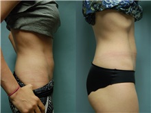 Nonsurgical Fat Reduction After Photo by Robert Lowen, MD; Mountain View, CA - Case 50190
