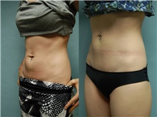 Nonsurgical Fat Reduction Before Photo by Robert Lowen, MD; Mountain View, CA - Case 50190