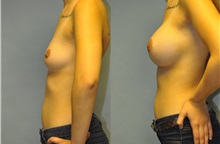 Breast Augmentation After Photo by Robert Lowen, MD; Mountain View, CA - Case 50195