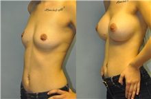 Breast Augmentation Before Photo by Robert Lowen, MD; Mountain View, CA - Case 50195