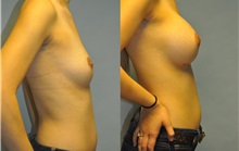 Breast Augmentation After Photo by Robert Lowen, MD; Mountain View, CA - Case 50195