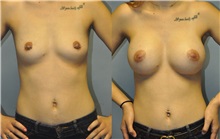 Breast Augmentation Before Photo by Robert Lowen, MD; Mountain View, CA - Case 50195