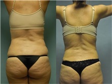 General Reconstruction After Photo by Robert Lowen, MD; Mountain View, CA - Case 50194