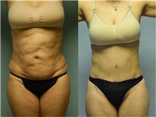 General Reconstruction Before Photo by Robert Lowen, MD; Mountain View, CA - Case 50194