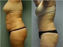 General Reconstruction After Photo by Robert Lowen, MD; Mountain View, CA - Case 50194