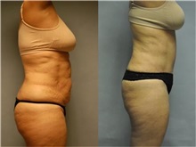 General Reconstruction Before Photo by Robert Lowen, MD; Mountain View, CA - Case 50194