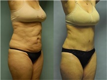 General Reconstruction After Photo by Robert Lowen, MD; Mountain View, CA - Case 50194