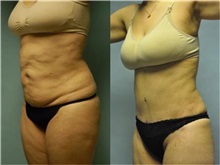 General Reconstruction Before Photo by Robert Lowen, MD; Mountain View, CA - Case 50194