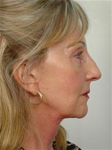 Facelift After Photo by R. Scott Yarish, MD; Houston, TX - Case 27620