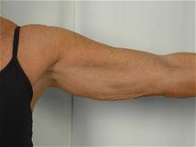 Arm Lift Before Photo by R. Scott Yarish, MD; Houston, TX - Case 27622