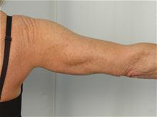Arm Lift After Photo by R. Scott Yarish, MD; Houston, TX - Case 27622