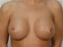 Breast Augmentation After Photo by R. Scott Yarish, MD; Houston, TX - Case 27623