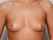 Breast Augmentation Before Photo by R. Scott Yarish, MD; Houston, TX - Case 27623