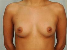 Breast Augmentation Before Photo by R. Scott Yarish, MD; Houston, TX - Case 27627