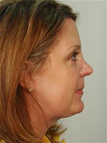 Facelift After Photo by R. Scott Yarish, MD; Houston, TX - Case 27629