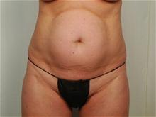 Tummy Tuck Before Photo by R. Scott Yarish, MD; Houston, TX - Case 27630
