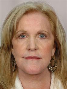 Facelift After Photo by R. Scott Yarish, MD; Houston, TX - Case 27631