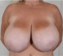 Breast Reduction Before Photo by R. Scott Yarish, MD; Houston, TX - Case 45948
