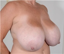 Breast Reduction Before Photo by R. Scott Yarish, MD; Houston, TX - Case 45948
