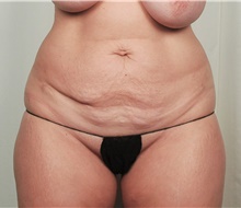 Tummy Tuck Before Photo by R. Scott Yarish, MD; Houston, TX - Case 45952