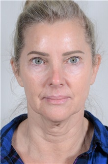 Facelift Before Photo by R. Scott Yarish, MD; Houston, TX - Case 45958