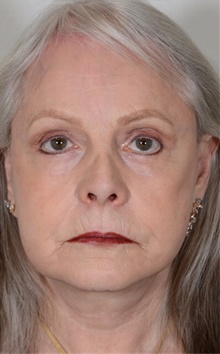 Facelift After Photo by R. Scott Yarish, MD; Houston, TX - Case 45960