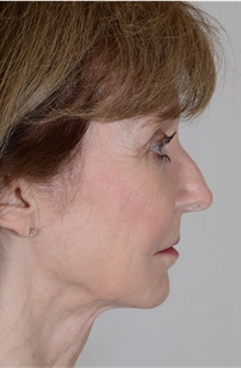 Facelift After Photo by R. Scott Yarish, MD; Houston, TX - Case 45961