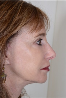 Facelift After Photo by R. Scott Yarish, MD; Houston, TX - Case 45962