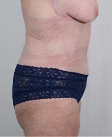 Tummy Tuck After Photo by R. Scott Yarish, MD; Houston, TX - Case 45965